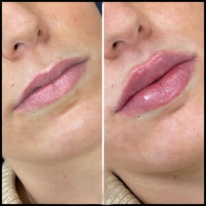 H7-Russian Lip Fillers