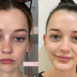 Best Doctors in dubai for Fillers: What Happens During the Procedure