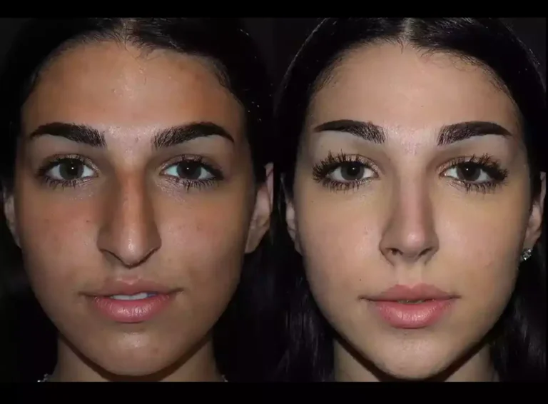 septoplasty in dubai