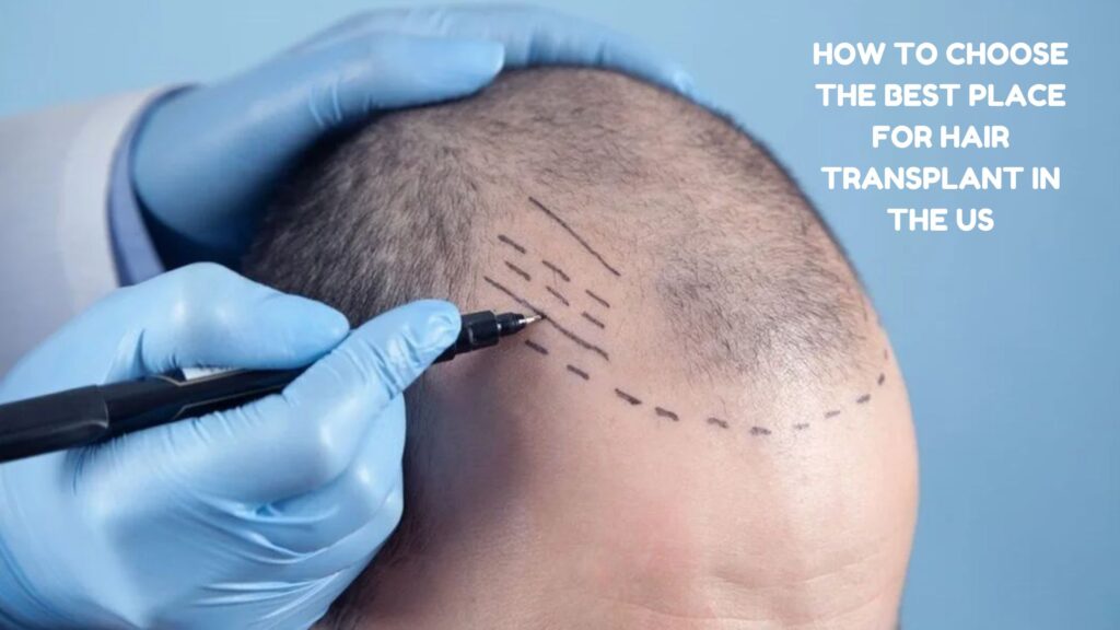 best place to get hair transplant