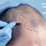 best place to get hair transplant