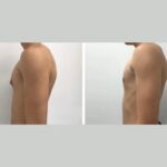 Gynecomastia surgery