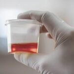 why-is-there-blood-in-my-urine-722x406