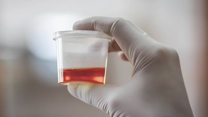 why-is-there-blood-in-my-urine-722x406