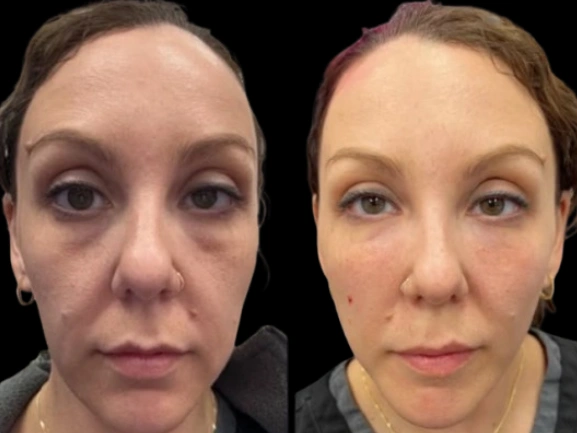 Dark Circles Treatment in Dubai: Does Diet and Nutrition Affect Dark Circles