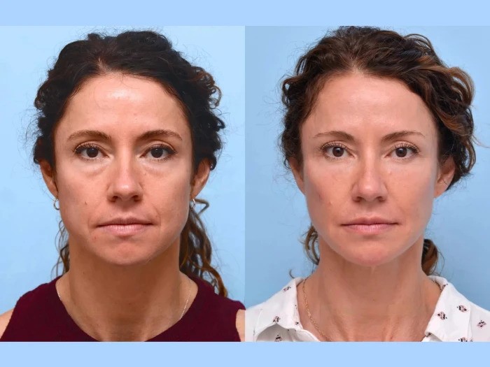 Age-Defying Thread Lift Results with the Best Plastic Surgeon in Dubai