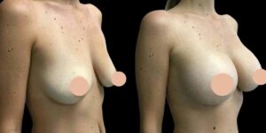 How the Best Breast Augmentation Surgeons in Dubai Support Your Unique Goals