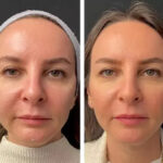 H2-Mesotherapy