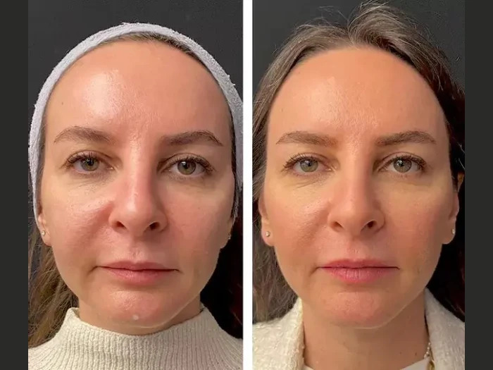 H2-Mesotherapy