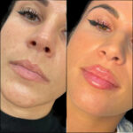 H6-lip-fillers (1)