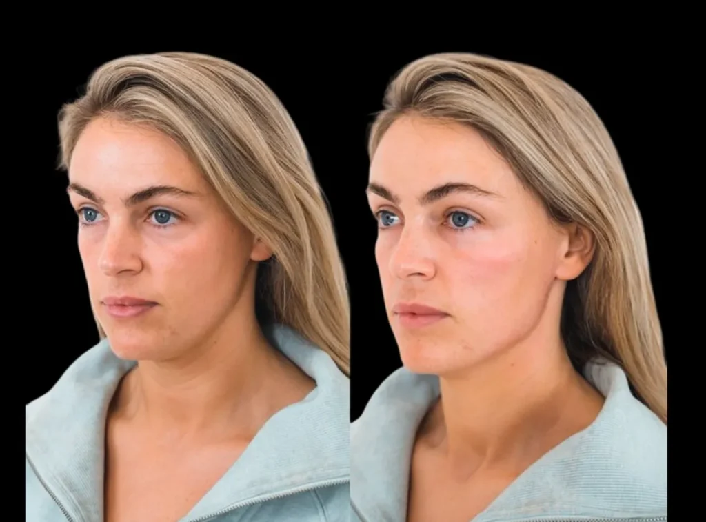 Cheek Fillers in Dubai