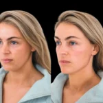 Cheek Fillers in Dubai