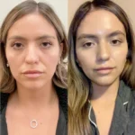 Best Aesthetic Clinics in Dubai: How Thread Lift Restores Youthful Facial Contours