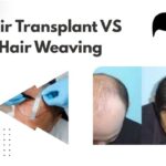 Hair Transplant VS Hair Weaving