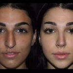 Septoplasty in dubai