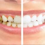 Tooth Crown Dubai