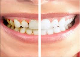 Tooth Crown Dubai