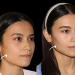 sculptra fillers in dubai