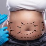 tummy-tuck-in-dubai (1)