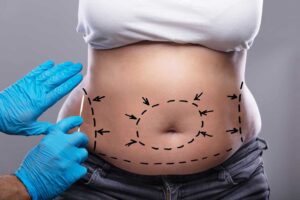 tummy-tuck-in-dubai (1)