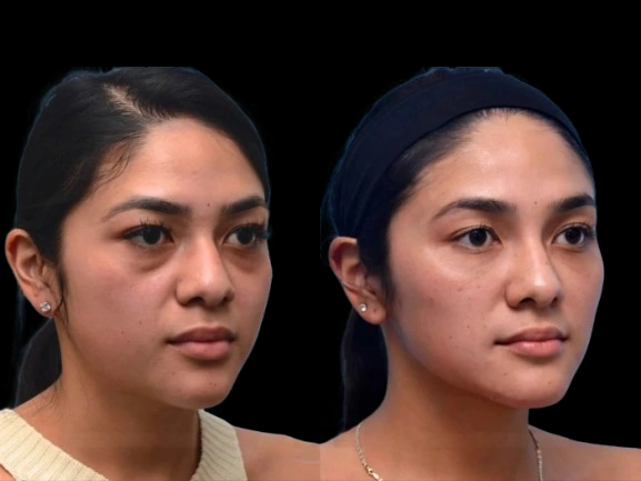 4-Dark-Circles-Treatment