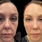 5-Dark-Circles-Treatment