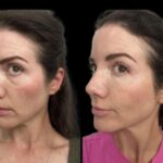 6-Dark-Circles-Treatment-ezgif.com-webp-to-jpg-converter
