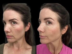 6-Dark-Circles-Treatment-ezgif.com-webp-to-jpg-converter