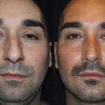 rhinoplasty in dubai