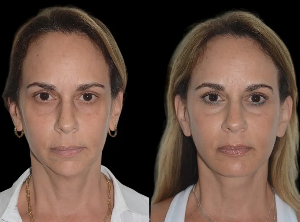 Chin Fillers in Dubai