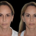 Chin Fillers in Dubai