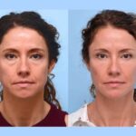 Safe and Effective Thread Lift Only at the Best Aesthetic Clinics in Dubai