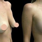 FAQs Answered by the Best Breast Augmentation Surgeons in Dubai