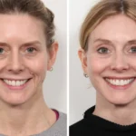 Thread Lift vs. Facelift: Advice from the Best Plastic Surgeons in Dubai