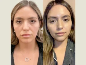 Best Doctors in Dubai Share Thread Lift Success Stories