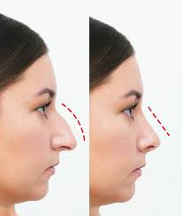 عملية تجميل الأنف في الرياض