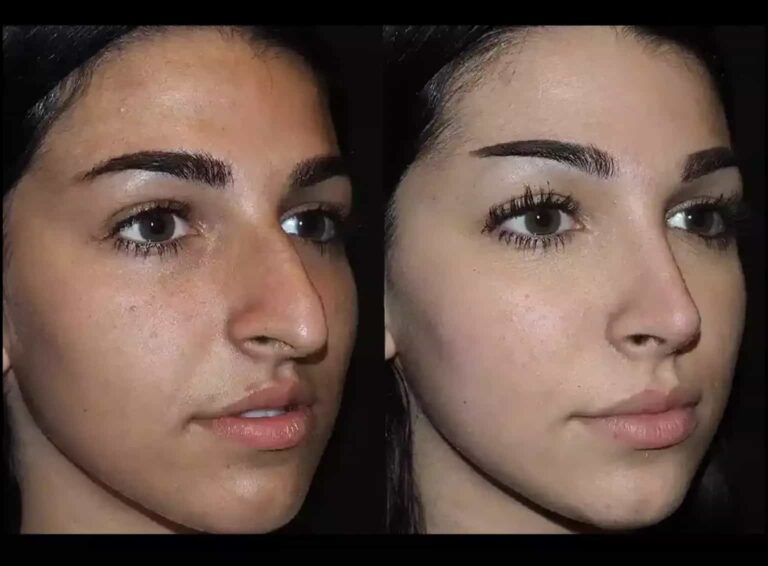 Septoplasty in Dubai