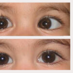 Ishwar Eye Centre – The Trusted Choice for the Best Squint Treatment in Rohtak