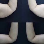 عملية شد الذراعين في الرياض