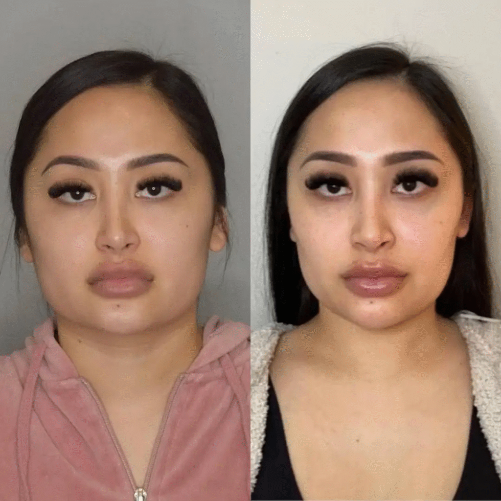 Buccal-Fat-Removal-surgery-before-and-after
