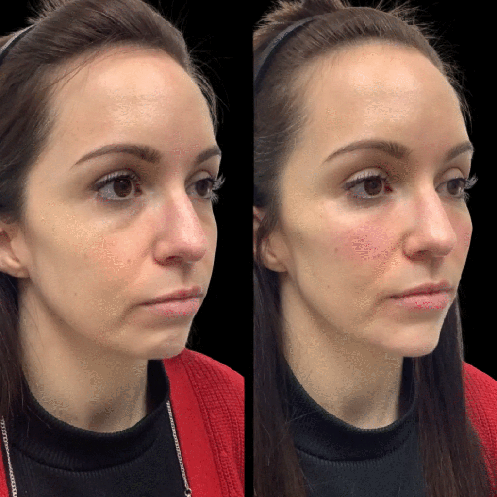 H1-Non-surgical-Facelift