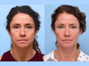 The Role of Collagen Stimulation in Thread lift Treatments in Dubai
