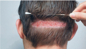 Hair Transplants in Pakistan