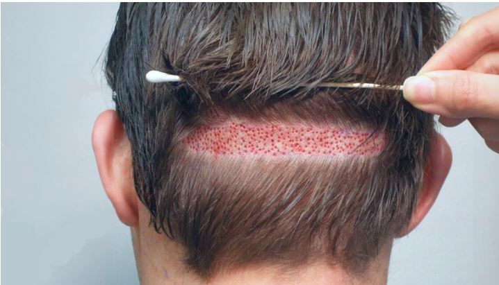 Hair Transplants in Pakistan