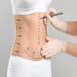Lipo-Abdominoplasty in Riyadh