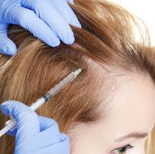 زراعة الشعر في الرياض.