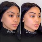 Thread Lift by Best Plastic Surgeon in Dubai for Non Surgical Lifting