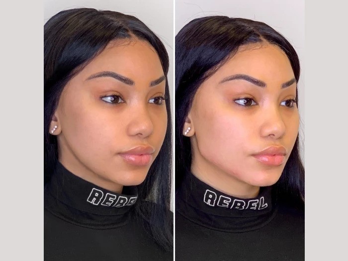Thread Lift by Best Plastic Surgeon in Dubai for Non Surgical Lifting