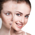 Effective Acne Care Starts with Tretiva 40 mg