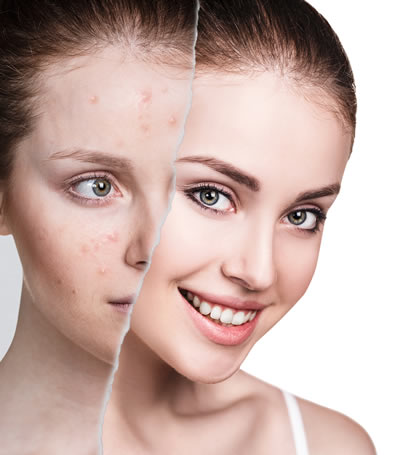 Effective Acne Care Starts with Tretiva 40 mg